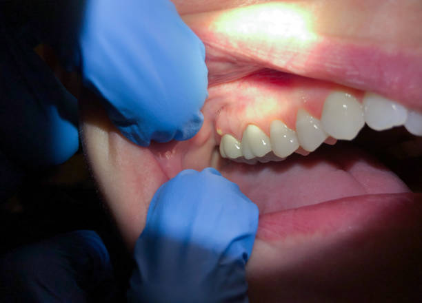 Best Emergency Gum Pain Relief  in August, CA